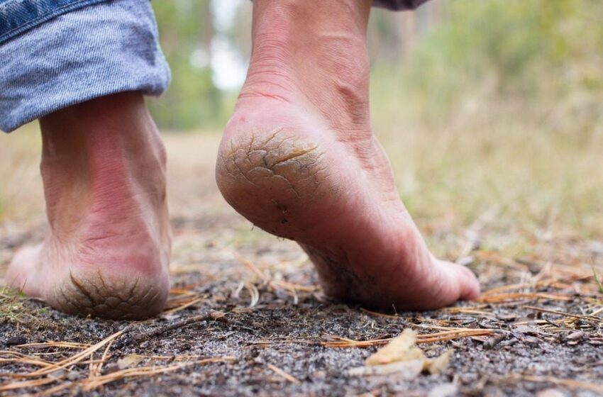  CREVASSES AUX TALONS DES PIEDS : Commun à tous, des solutions existent pour radier ce mal