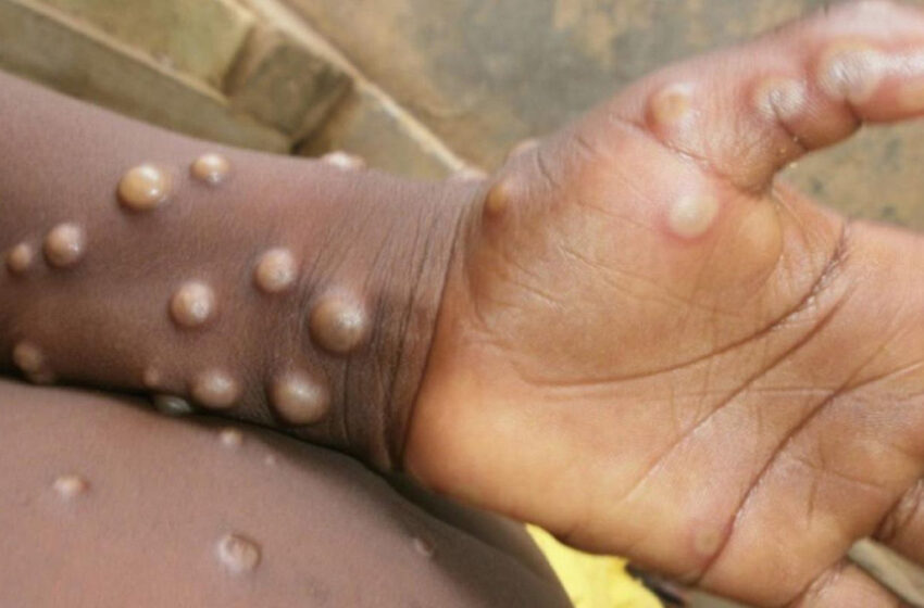  ÉVOLUTION DES DIFFÉRENTES SOUCHES DU VIRUS MPOX : Quel risque pour l’Afrique et le reste du monde ?