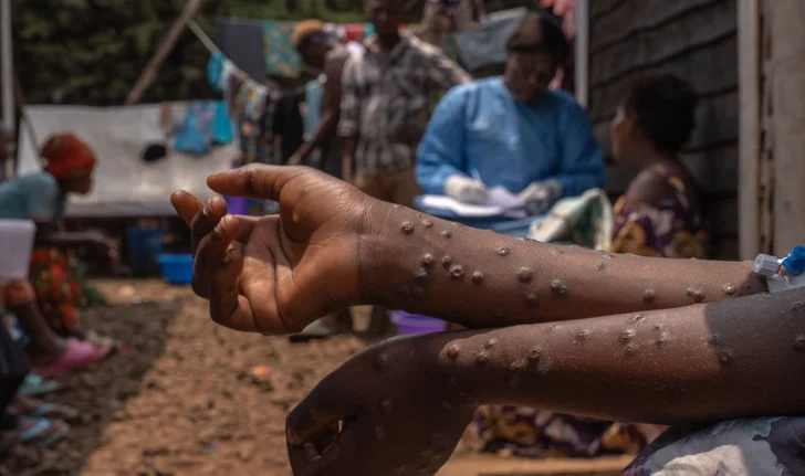 Le Togo vient de confirmer son tout premier cas de Mpox ou variole simienne. Il s'agit d'une jeune femme hospitalisée à Lomé. Face à cette situation, le gouvernement togolais a déclenché plusieurs mesures pour prévenir la propagation de cette maladie virale.