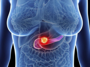 Le cancer affecte près de 19 millions de personnes chaque année dans le monde. Pourtant, selon l’Organisation mondiale de la santé (OMS), plus d’un tiers de ces cas pourrait être évité grâce à la prévention. Une nouvelle étude pointe les facteurs de risque modifiables et appelle à l'action.